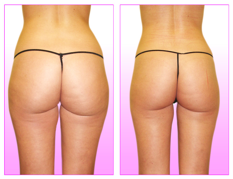 Traitement anti cellulite avant apres opération